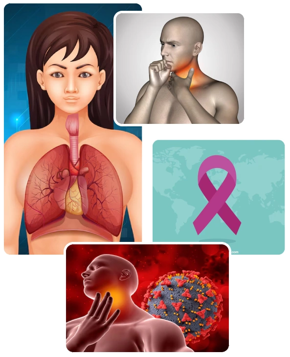 Treatment of Oropharynx Cancer Treatment of Oropharynx Cancer