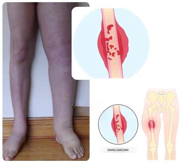 Stages of Ewing Sarcoma cancer Stages of Ewing Sarcoma cancer