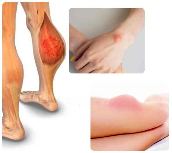 Stages of Liposarcoma Cancer