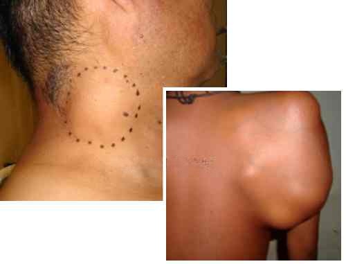 Causes of Liposarcoma Cancer