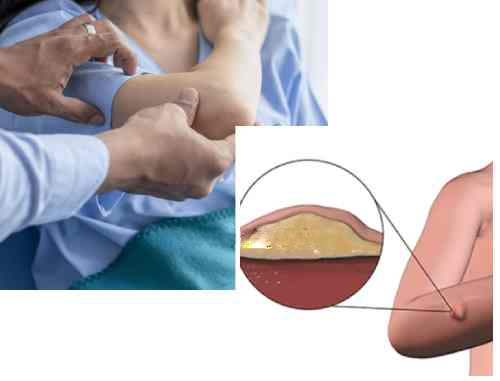 Treatments for Liposarcoma Cancer
