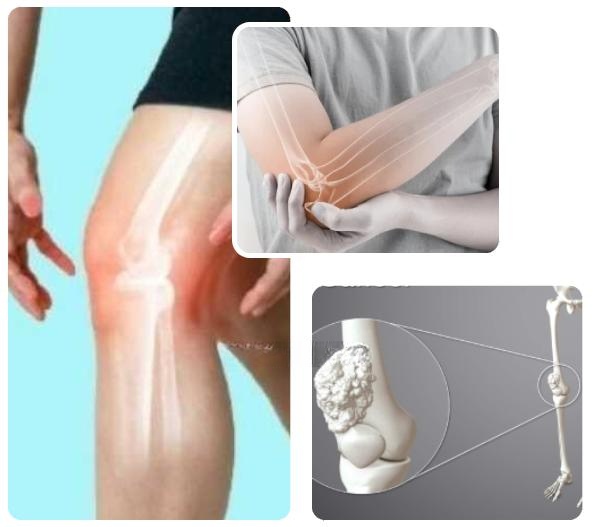Stages of Bone Cancer Stages of Bone Cancer