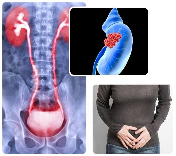 Causes of Ureteral Cancer Causes of Ureteral Cancer