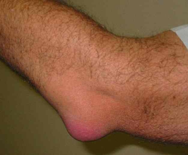 Liposarcoma Cancer