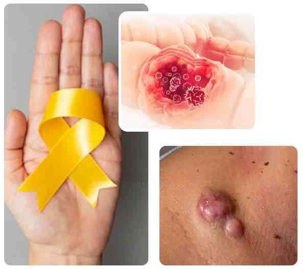 Causes of Sarcoma Cancer Causes of Sarcoma Cancer<br />