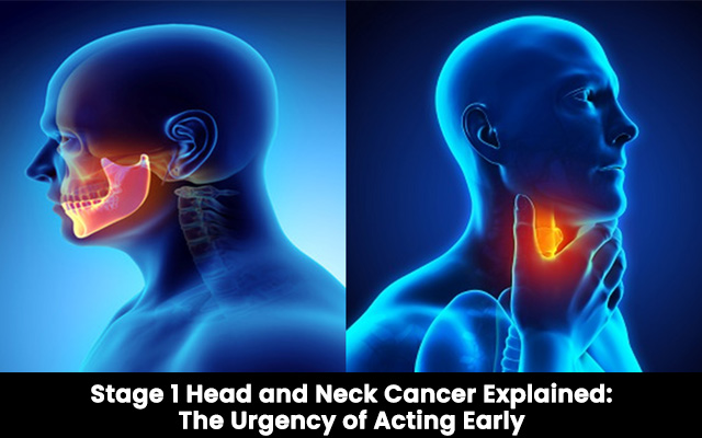 Stage 1 head and neck cancer explained: The urgency of acting early