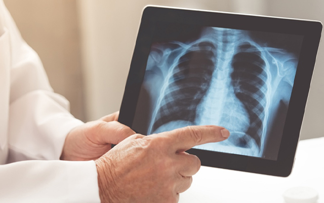 lung cancer detection